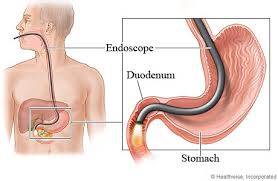 endoskopi nasıl yapılır